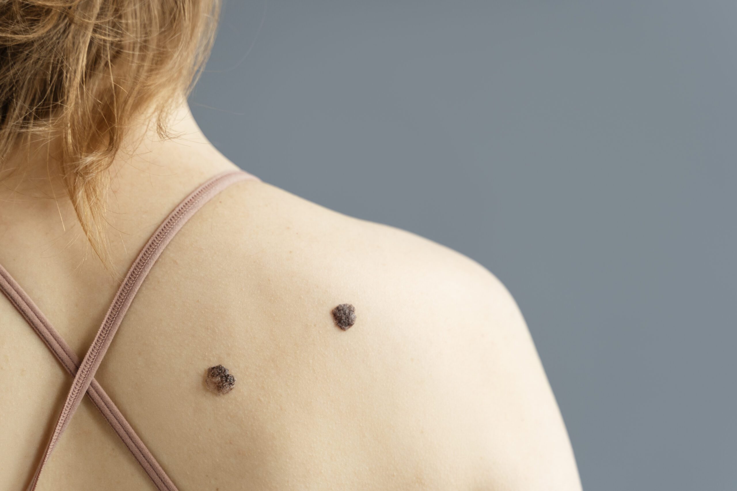 Symptoms of Skin Cancer & Treatment | Three Kings Accident & Medical Clinic